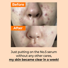 Load image into Gallery viewer, Numbuzin No.5 Goodbye Blemish Serum 50ml