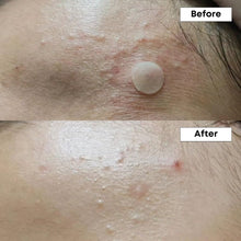 Load image into Gallery viewer, NINELESS A-Control 10% Azelaic Acid Serum 30ml