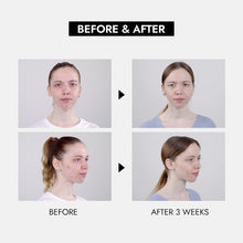 Load image into Gallery viewer, Step by Step Acne Self Care Box