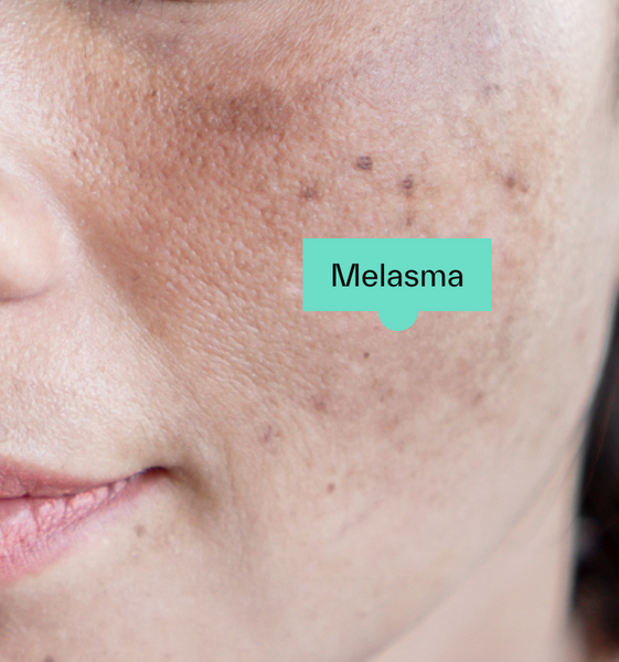 Melasma Is No Match for This $23 K-Beauty Serum