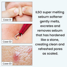 Load image into Gallery viewer, ILSO Super Melting Sebum Softener 150ml